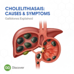 Cholerhiasis: Complete Guide to Causes, Symptoms, Treatment and Prevention